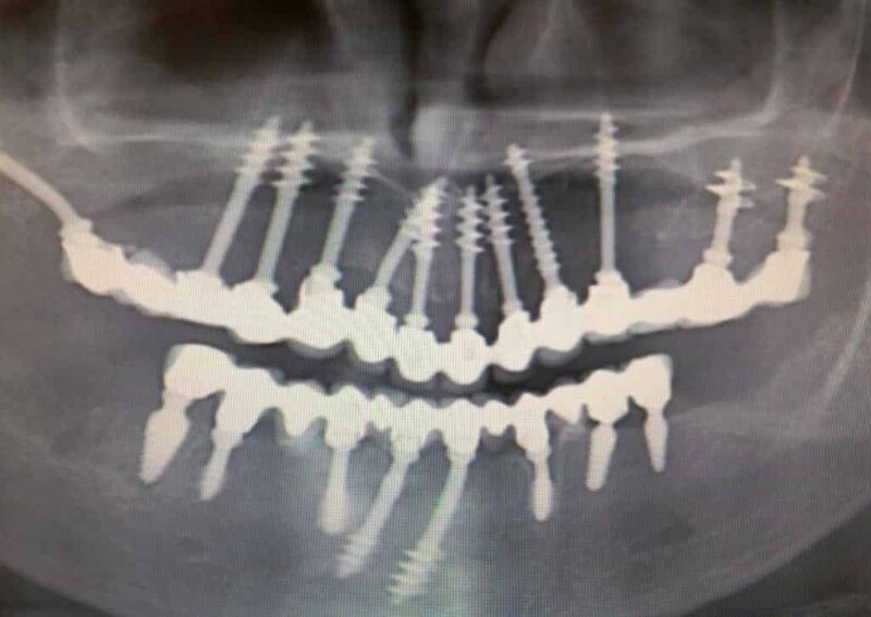 fog implantátum