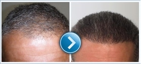 hair transplant clinic